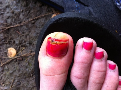 The toenail